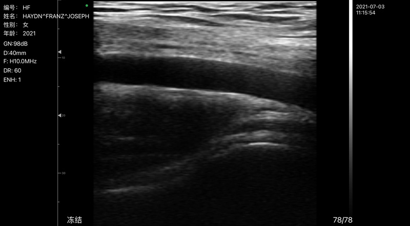 Wireless Ultrasound for Achsel arterie C