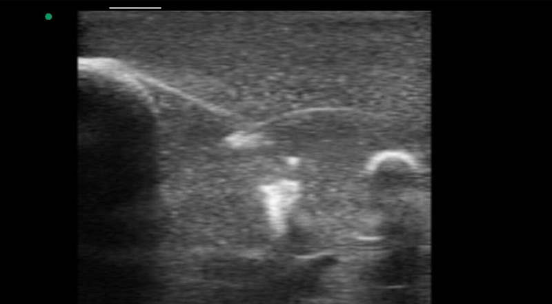 Wireless Ultrasound for Brust biopsie training