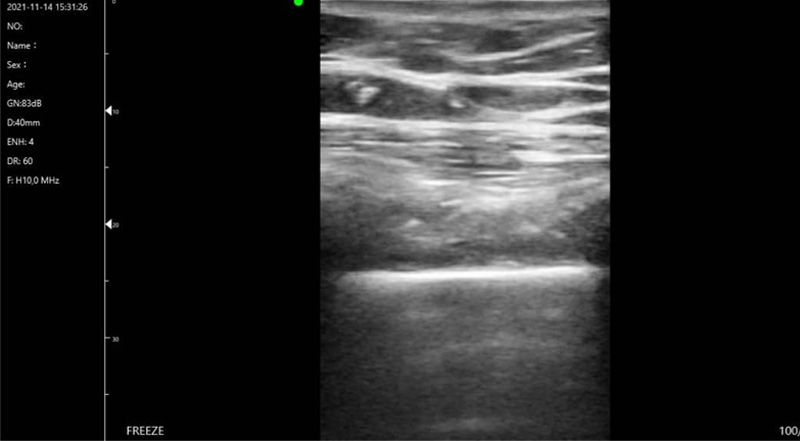 Wireless Ultrasound for C10T Lunge