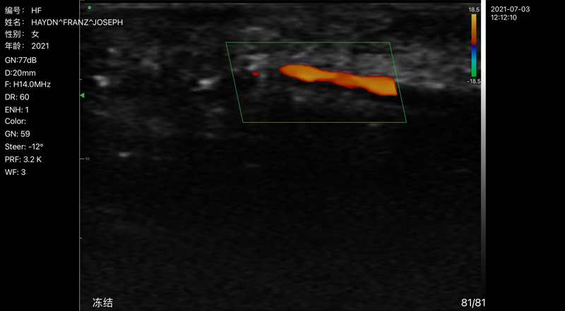 Wireless Ultrasound for Finger arterie