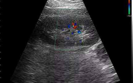 Ultraschall-Nieren C Abdominal sonden