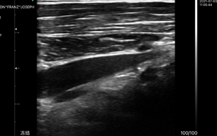 Bauch-Ultraschall-Sonde Leber B