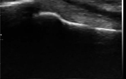 Gebogene lineare Ultraschall-Sonde Finger-Flexor-Tendon