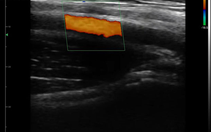 Lineare Array-Sonde Ultraschall-Achsel arterie C