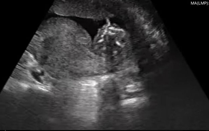 Ultraschall Fetal B Ganzkörper abdomen